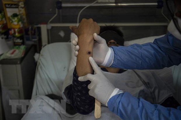 Argentina xác nhận ca tử vong đầu tiên do bệnh đậu mùa khỉ